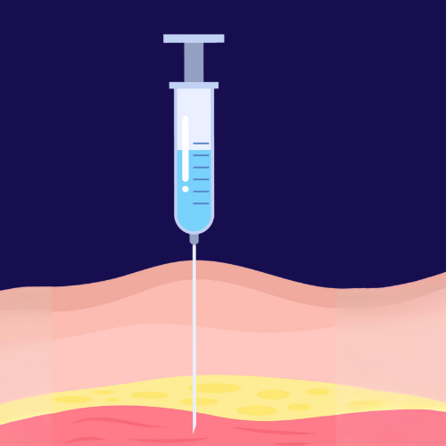 Intramuscular injection technique